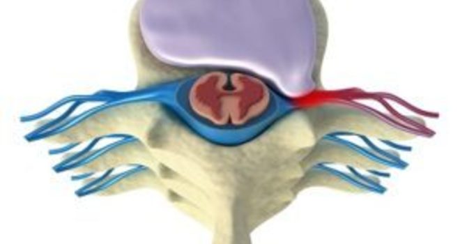 How Chiropractic Can Treat A Herniated Disc image