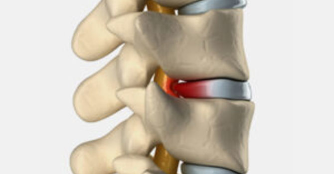 Lumbar Degeneration: What Can I Do to Help with My Back Pain? image