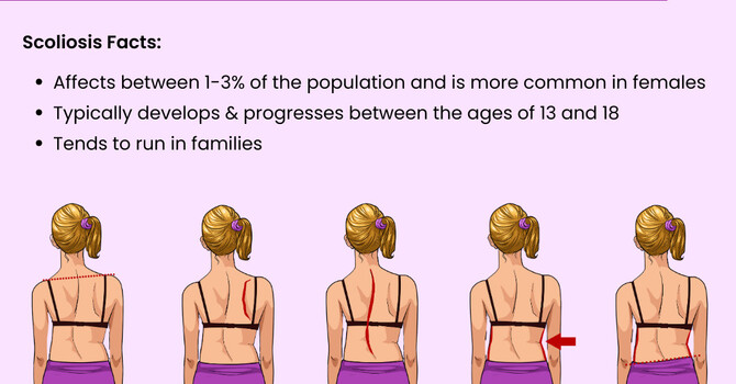 Can Chiropractic Care Help with Adolescent Scoliosis?  image